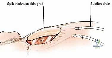 صورة توضيحية لـ استئصال الربع الأمامي: دليل شامل للمرضى مع الأستاذ الدكتور محمد هطيف