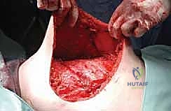 Illustration of forequarter amputation forequarter - Dr. Mohammed Hutaif