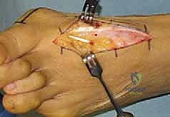 إعادة محاذاة العظام وتصحيح الزوايا