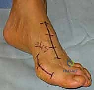 إزالة الغضروف وإعداد المفصل للدمج