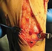 الشق الجراحي والوصول إلى المفصل الرسغي المشطي