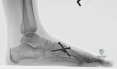 صورة شعاعية توضح التثبيت النهائي لعملية لابيدوس