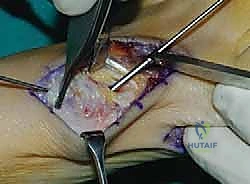 التشخيص الإشعاعي الدقيق لزوايا إبهام القدم الأروح