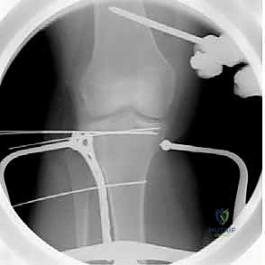 Illustration of lateral tibial plateau fractures - Dr. Mohammed Hutaif