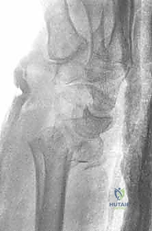 صورة توضح آلية الإصابة عالية الطاقة