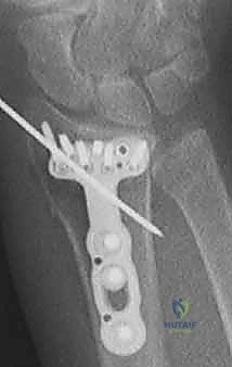 تأثير السقوط على اليد الممدودة