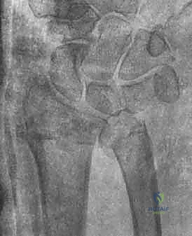 توضيح لكسور الجزء الكردوسي الكردوسي