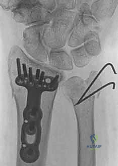 الفحص السريري الدقيق لكسور الزند