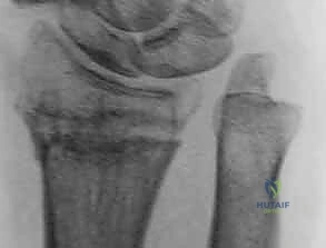 استخدام الجبائر في العلاج التحفظي