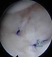 صورة توضيحية لـ علاج كسور عظم الزند: دليل شامل لكسور الناتئ الإبري، الرأس، والجزء الكردوسي الكردوسي مع الأستاذ الدكتور محمد هطيف في صنعاء