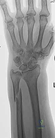 صورة طبية: علاج كسور عظم الزند: دليل شامل لكسور الناتئ الإبري، الرأس، والجزء الكردوسي الكردوسي مع الأستاذ الدكتور محمد هطيف في صنعاء