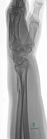 صورة طبية: علاج كسور عظم الزند: دليل شامل لكسور الناتئ الإبري، الرأس، والجزء الكردوسي الكردوسي مع الأستاذ الدكتور محمد هطيف في صنعاء