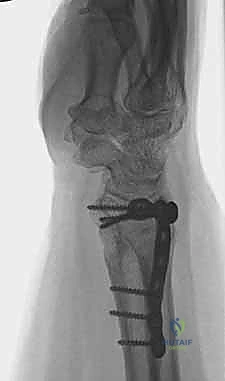 صورة طبية: علاج كسور عظم الزند: دليل شامل لكسور الناتئ الإبري، الرأس، والجزء الكردوسي الكردوسي مع الأستاذ الدكتور محمد هطيف في صنعاء