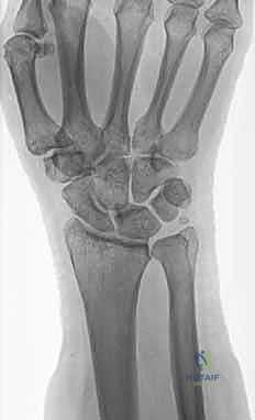 صورة طبية: علاج كسور عظم الزند: دليل شامل لكسور الناتئ الإبري، الرأس، والجزء الكردوسي الكردوسي مع الأستاذ الدكتور محمد هطيف في صنعاء