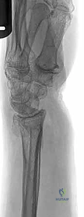 صورة طبية: علاج كسور عظم الزند: دليل شامل لكسور الناتئ الإبري، الرأس، والجزء الكردوسي الكردوسي مع الأستاذ الدكتور محمد هطيف في صنعاء