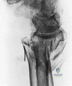 صورة طبية: علاج كسور عظم الزند: دليل شامل لكسور الناتئ الإبري، الرأس، والجزء الكردوسي الكردوسي مع الأستاذ الدكتور محمد هطيف في صنعاء