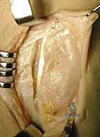 صورة توضيحية لـ علاج كسور عظم الزند: دليل شامل لكسور الناتئ الإبري، الرأس، والجزء الكردوسي الكردوسي مع الأستاذ الدكتور محمد هطيف في صنعاء