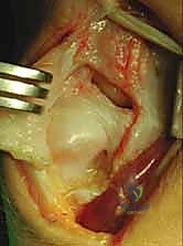 صورة طبية: علاج كسور عظم الزند: دليل شامل لكسور الناتئ الإبري، الرأس، والجزء الكردوسي الكردوسي مع الأستاذ الدكتور محمد هطيف في صنعاء