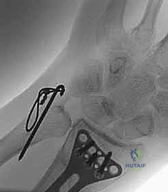 صورة طبية: علاج كسور عظم الزند: دليل شامل لكسور الناتئ الإبري، الرأس، والجزء الكردوسي الكردوسي مع الأستاذ الدكتور محمد هطيف في صنعاء