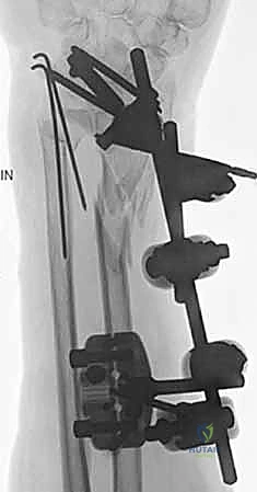 صورة طبية: علاج كسور عظم الزند: دليل شامل لكسور الناتئ الإبري، الرأس، والجزء الكردوسي الكردوسي مع الأستاذ الدكتور محمد هطيف في صنعاء