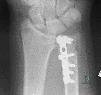 صورة طبية: علاج كسور عظم الزند: دليل شامل لكسور الناتئ الإبري، الرأس، والجزء الكردوسي الكردوسي مع الأستاذ الدكتور محمد هطيف في صنعاء