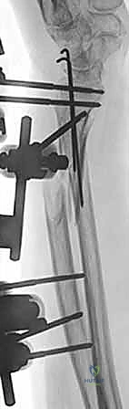 صورة طبية: علاج كسور عظم الزند: دليل شامل لكسور الناتئ الإبري، الرأس، والجزء الكردوسي الكردوسي مع الأستاذ الدكتور محمد هطيف في صنعاء