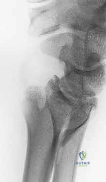 صورة طبية: علاج كسور عظم الزند: دليل شامل لكسور الناتئ الإبري، الرأس، والجزء الكردوسي الكردوسي مع الأستاذ الدكتور محمد هطيف في صنعاء