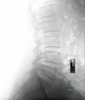 أسباب عدم الاستقرار في العمود الفقري
