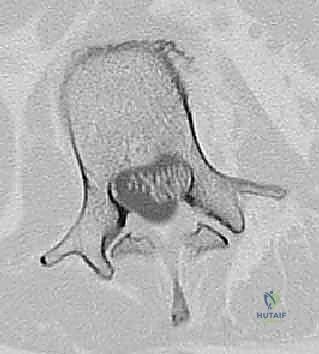 التصوير المقطعي ثلاثي الأبعاد للعمود الفقري