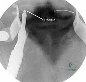 التخطيط الجراحي لوضع المسامير في السويقات