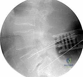 صورة توضيحية لـ دمج الفقرات الصدرية القطنية الخلفي الجانبي بالتثبيت بالأدوات: حل شامل لآلام الظهر وعدم الاستقرار