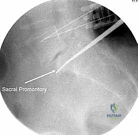 صورة طبية: دمج الفقرات الصدرية القطنية الخلفي الجانبي بالتثبيت بالأدوات: حل شامل لآلام الظهر وعدم الاستقرار
