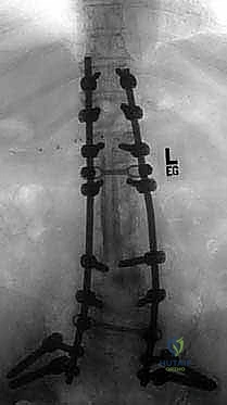 صورة طبية: دمج الفقرات الصدرية القطنية الخلفي الجانبي بالتثبيت بالأدوات: حل شامل لآلام الظهر وعدم الاستقرار