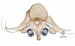 صورة طبية: دمج الفقرات الصدرية القطنية الخلفي الجانبي بالتثبيت بالأدوات: حل شامل لآلام الظهر وعدم الاستقرار