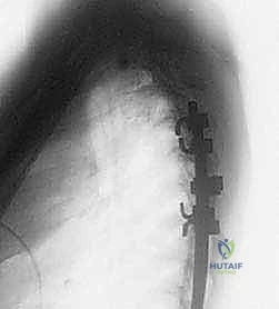 صورة طبية: دمج الفقرات الصدرية القطنية الخلفي الجانبي بالتثبيت بالأدوات: حل شامل لآلام الظهر وعدم الاستقرار