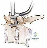 صورة طبية: دمج الفقرات الصدرية القطنية الخلفي الجانبي بالتثبيت بالأدوات: حل شامل لآلام الظهر وعدم الاستقرار