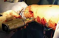 Submuscular Bridge Plating of Pediatric Femoral Shaft Fractures: An Intraoperative Masterclass