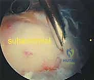Illustration of arthroscopic capsular release - Dr. Mohammed Hutaif