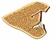 صورة توضح التئام خاطئ لكسر الكعبرة بسبب إهمال طبي