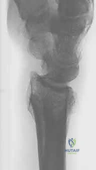 تخطيط جراحي دقيق قبل العملية - د. محمد هطيف