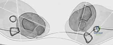 أشعة مقطعية ثلاثية الأبعاد لتشوه الكعبرة