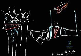 استعادة الطول الطبيعي للكعبرة