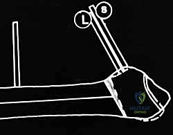 وضع الطعم العظمي في الفراغ