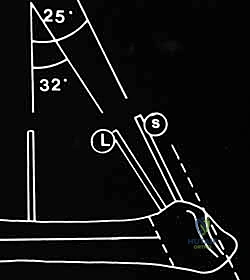 تجهيز الطعم العظمي