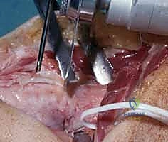 تأثير قصر الكعبرة على مفصل الرسغ