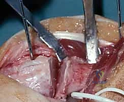 متلازمة انحشار الزند بسبب تشوه الكعبرة