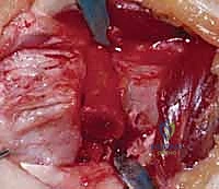 التأكد من استقرار الطعم العظمي