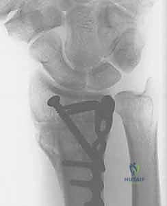 الأشعة السينية توضح زوايا الكعبرة الطبيعية