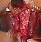 أشعة سينية توضح زوايا التشوه قبل الجراحة