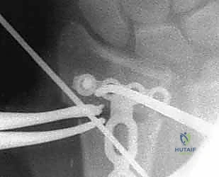 صورة طبية: عملية تصحيح تشوه الكعبرة البعيدة: استعادة دقيقة لوظيفة الرسغ مع الأستاذ الدكتور محمد هطيف في صنعاء